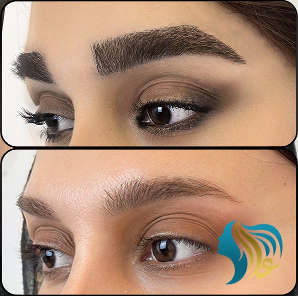 شستن بخیه سر بعد از کاشت ابرو