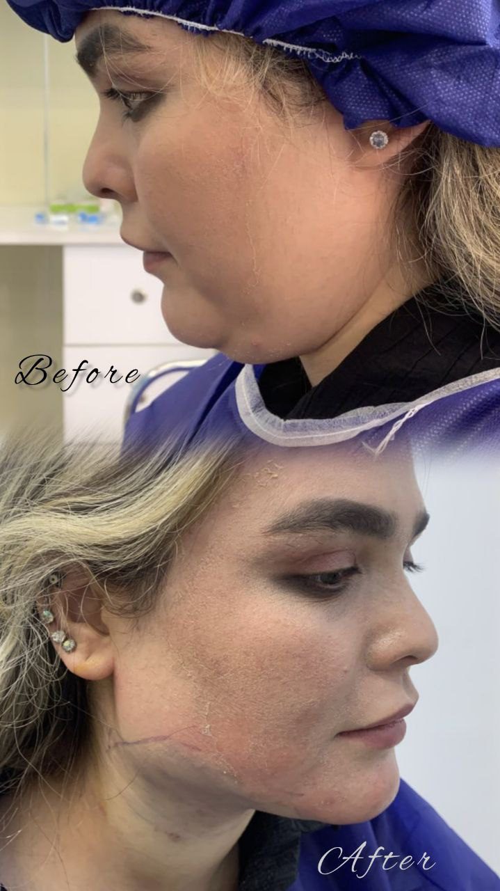 ساکشن غبغب قیمت