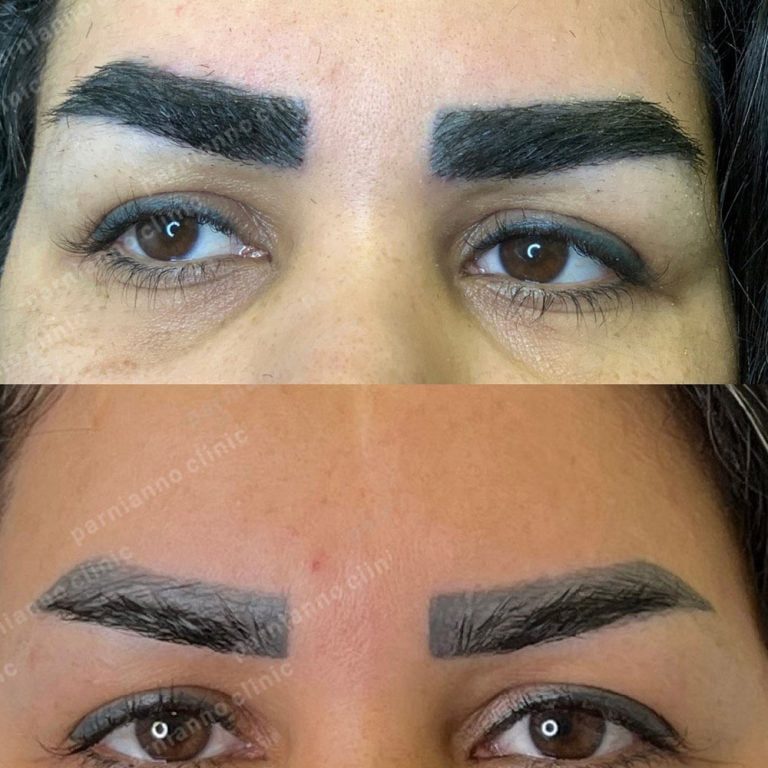 قبل و بعد کاشت ابرو در کلینیک پرنیام نو