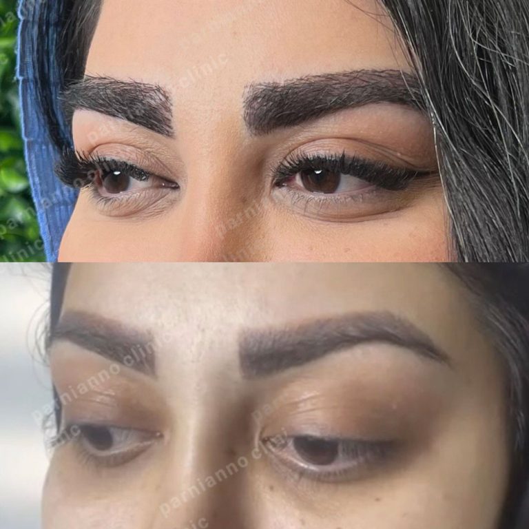 قبل و بعد کاشت ابرو در کلینیک پرنیام نو