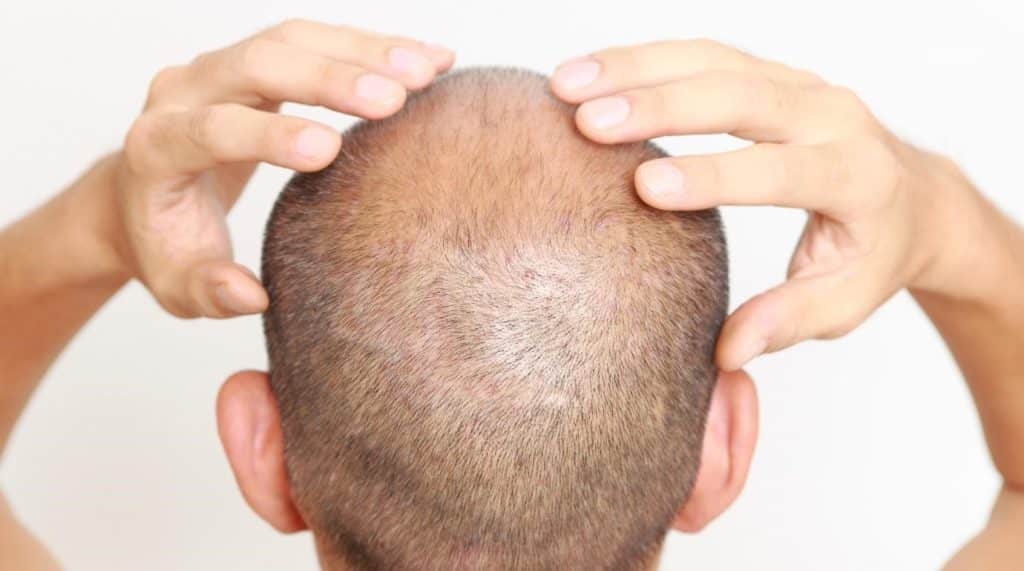 مراقبت های بعد از کاشت مو