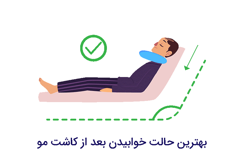 کاشت مو مراقبت های بعد از کاشت مو