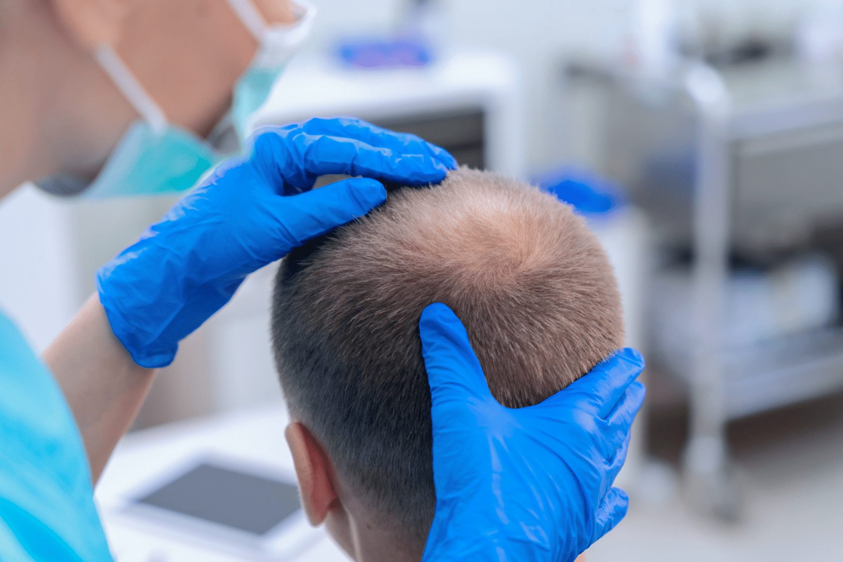 ریزش مو بعد از کاشت