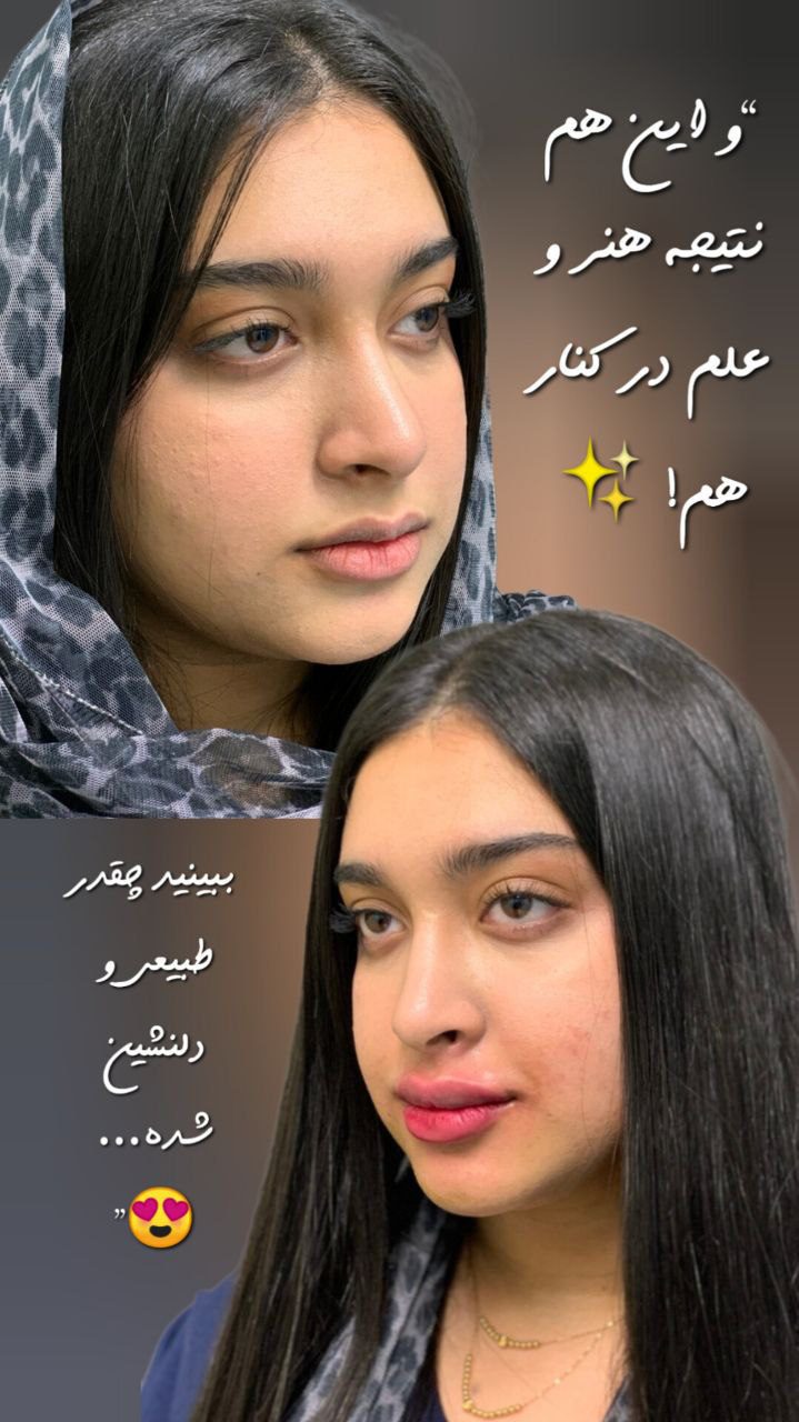 تزریق ژل لب