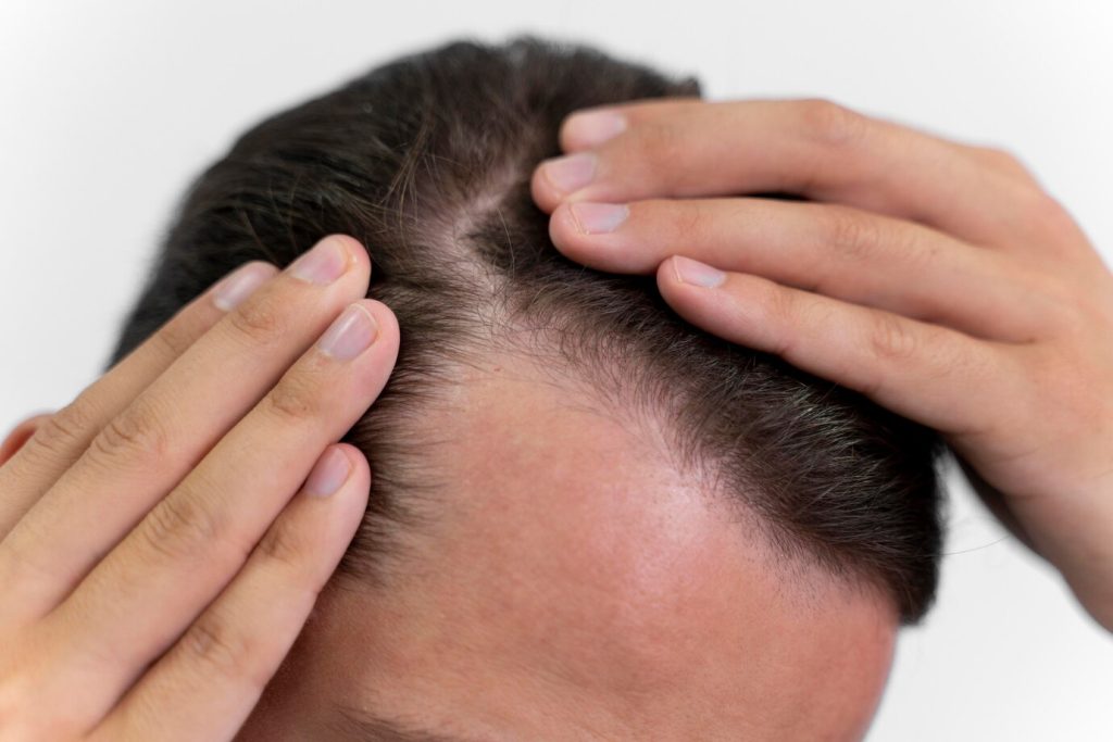 آیا کاشت مو برای همه مناسب است؟
