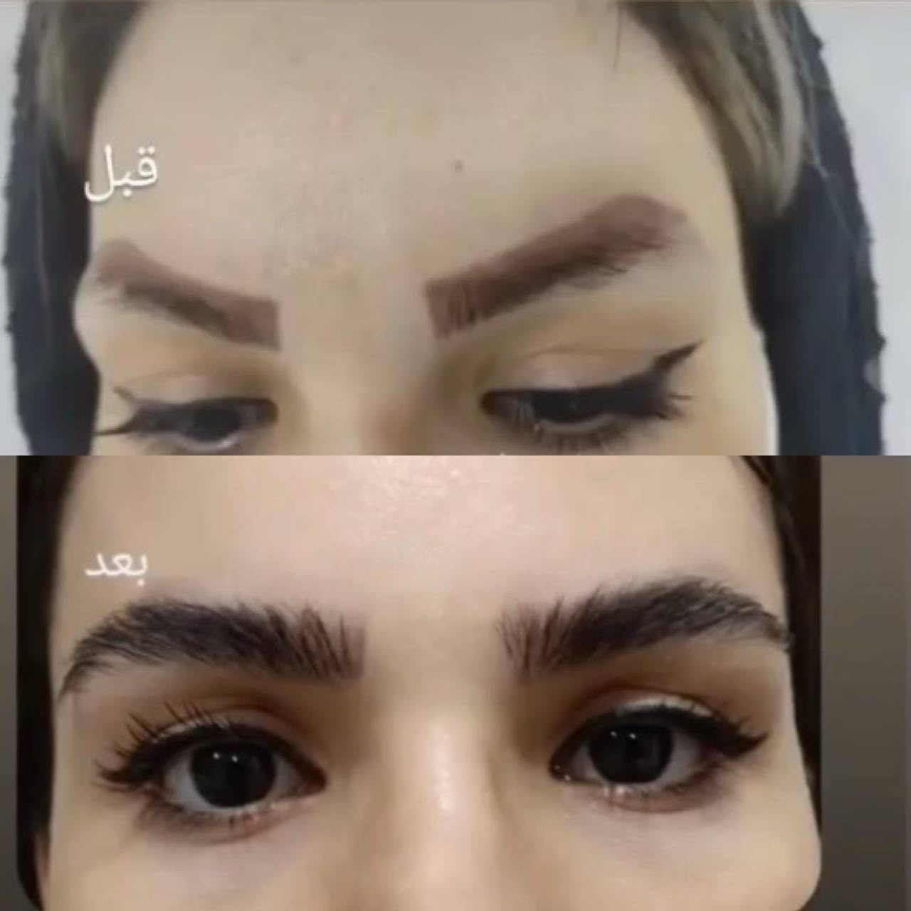 هزینه پاک کردن تاتو با لیزر