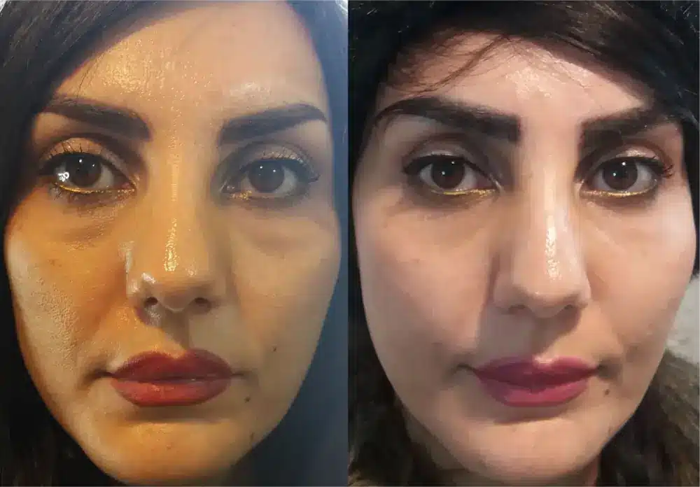 تزریق چربی